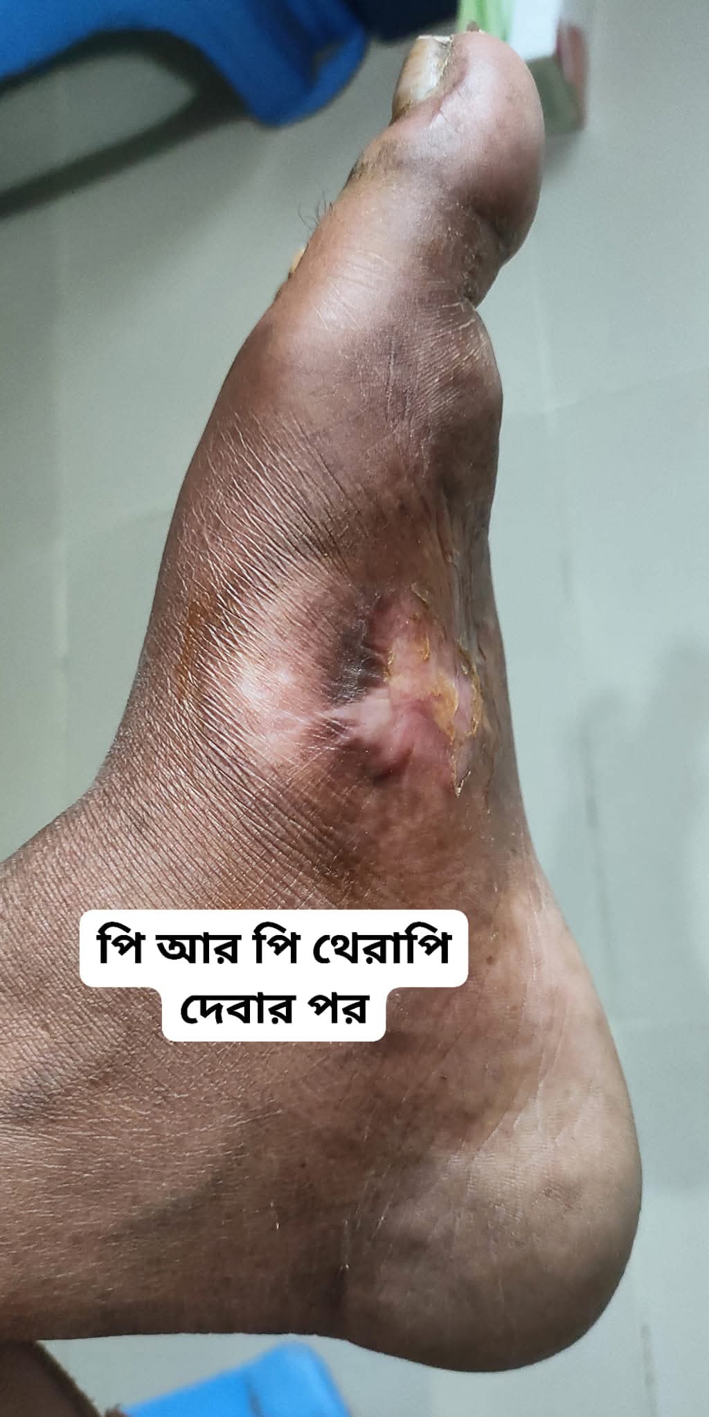 After Skin Treatment