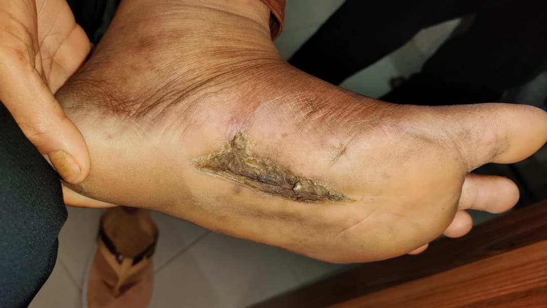 After PRP Therapy