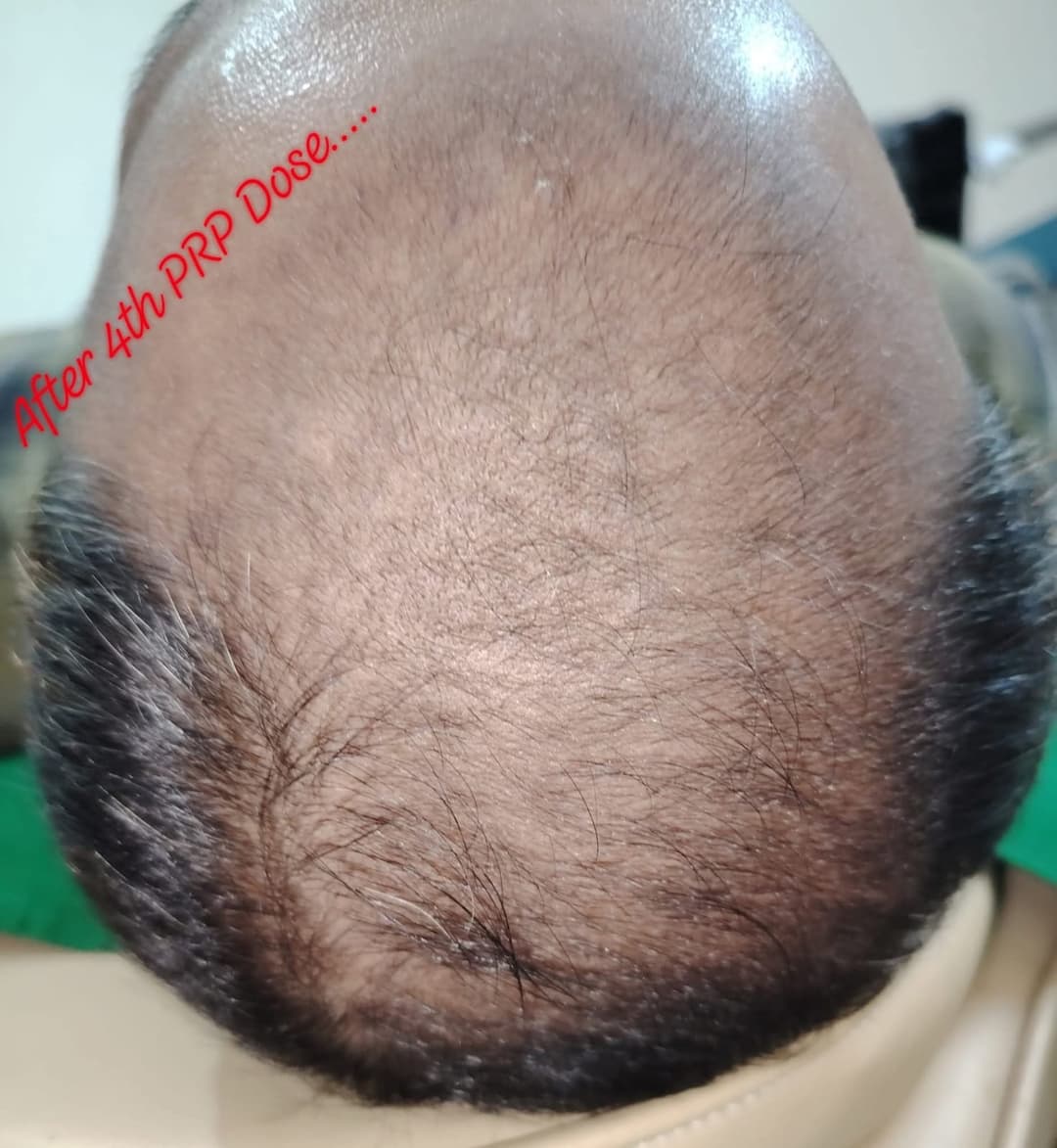 After PRP Therapy