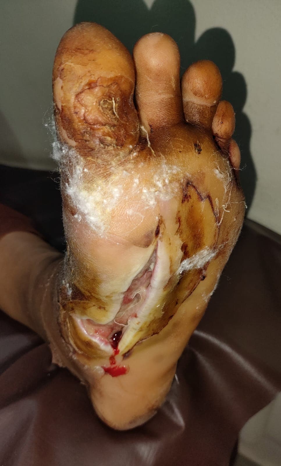 Before PRP Therapy