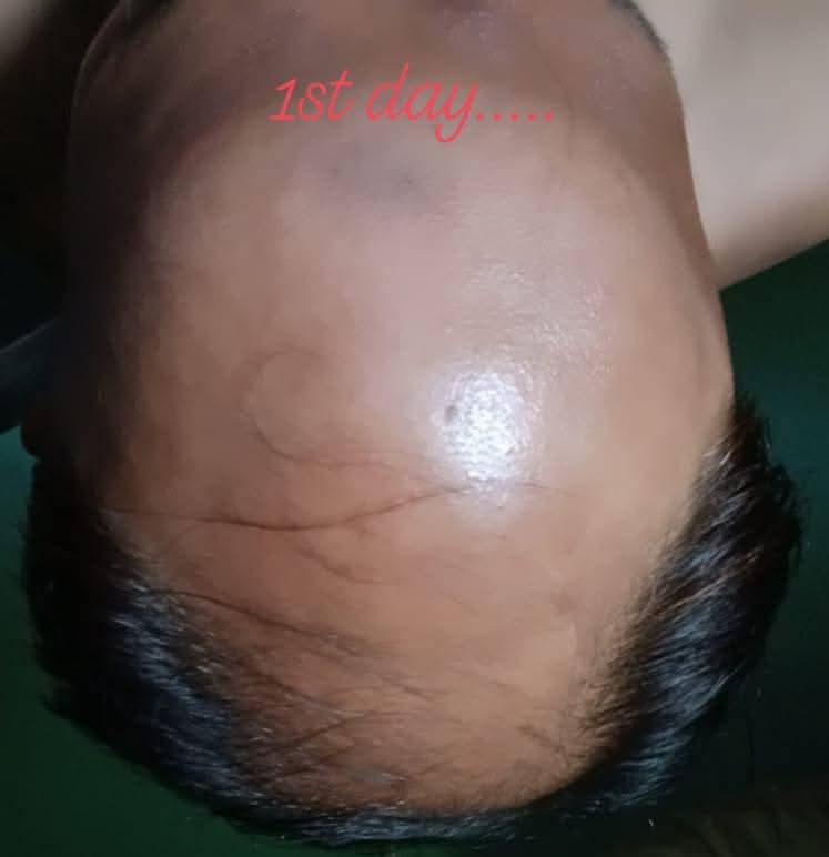 Before PRP Therapy